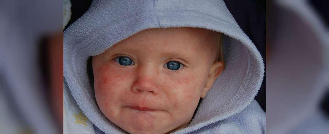 Child with measles by Dave Haygarth via Flickr