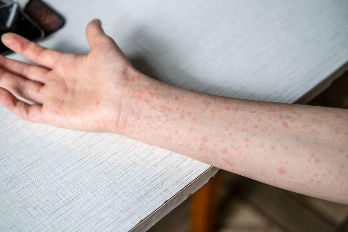 Measles rash. (Photo by Natalya Maisheva/iStock / Getty Images Plus)