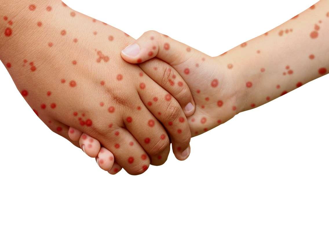 Measles.  © Can Stock Photo / focalpoint