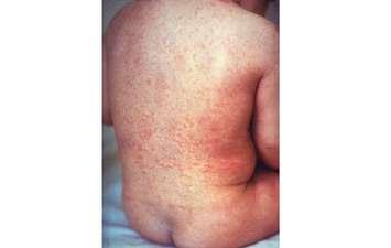 rubella. (Photo courtesy of Centers for Disease Control and Prevention)